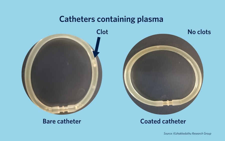 Image: Catheters coated with the new material showed a significant reduction in clotting on the device surface (Photo courtesy of UBC Faculty of Medicine)